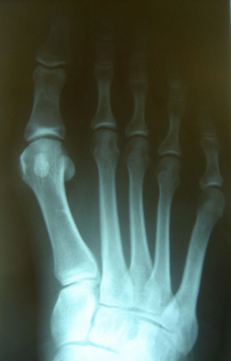 Bunions - an enlargement of the big toe joint